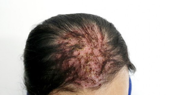 Ung thư da đầu – Nguyên nhân, triệu chứng, điều trị và phòng bệnh hiệu quả