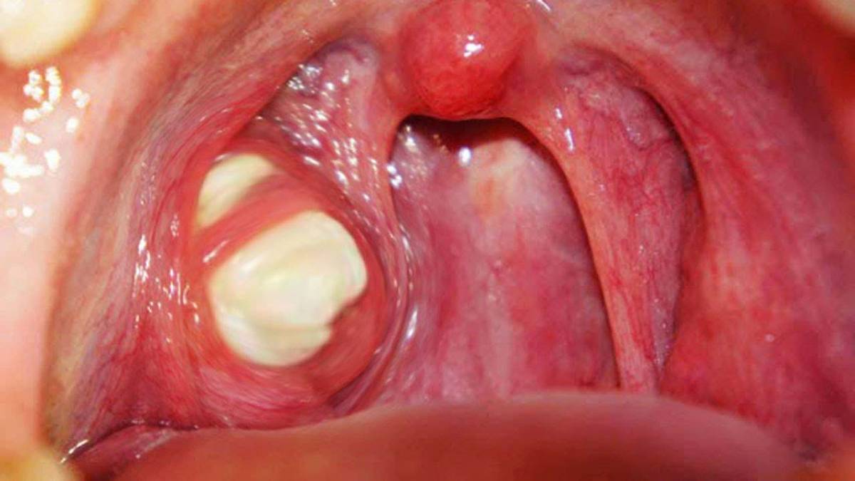 Phân biệt ung thư vòm họng với viêm amidan