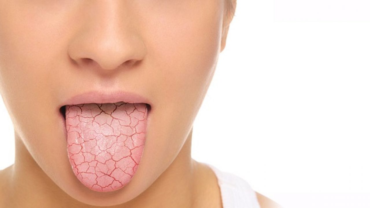 Khô miệng do xạ trị ung thư vòm họng