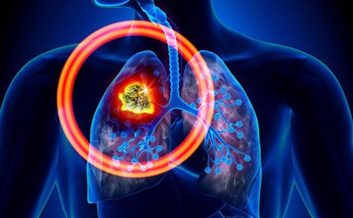 Ung thư phổi là gì